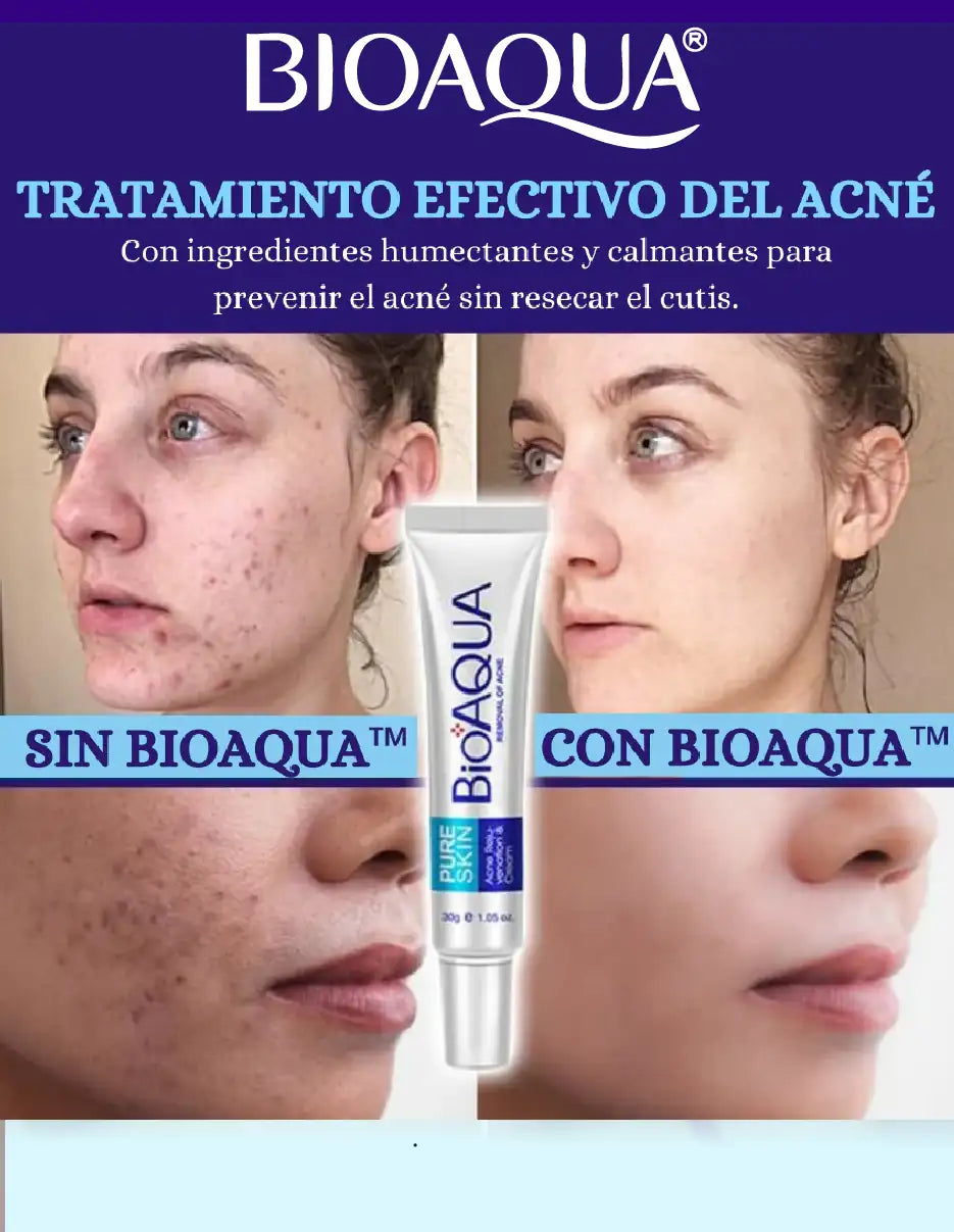 CREMA ANTI ACNE BIOAQUA [PV1-TIKTOK-HYPEIMPORTS]