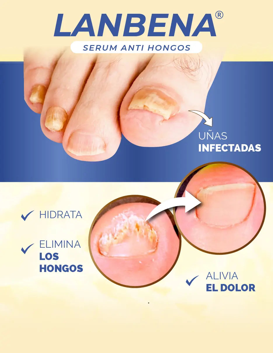 REMOVEDOR DE HONGOS LANBENA [PV1-TIKTOK-HYPEIMPORTS]